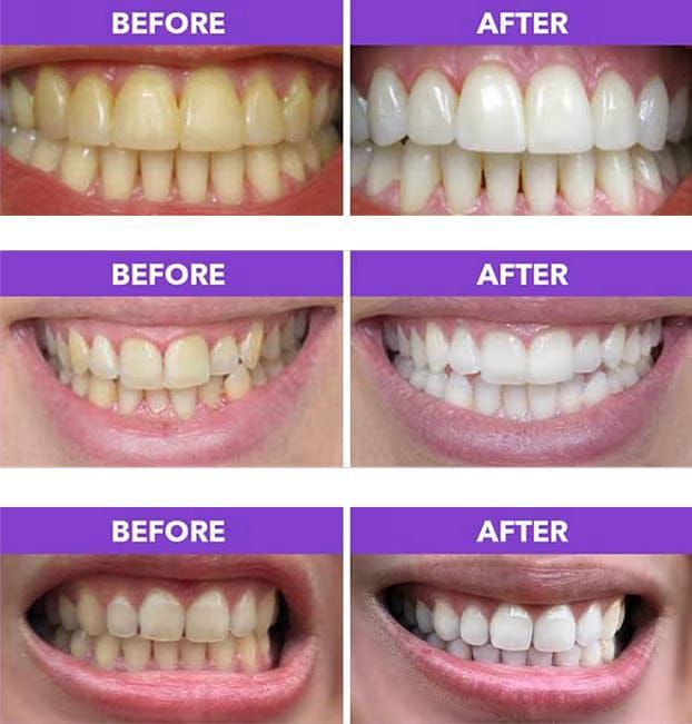 Oralhoe Shine Whitening Patches