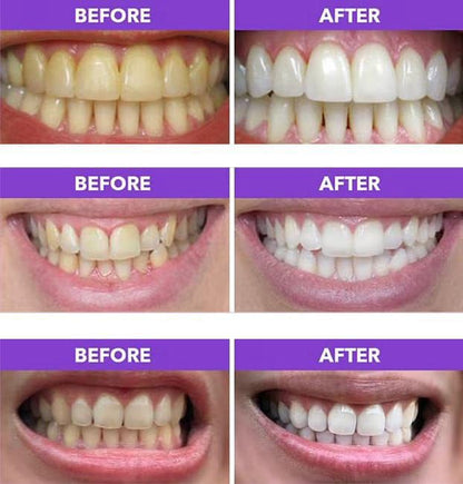 Oralhoe Shine Whitening Patches